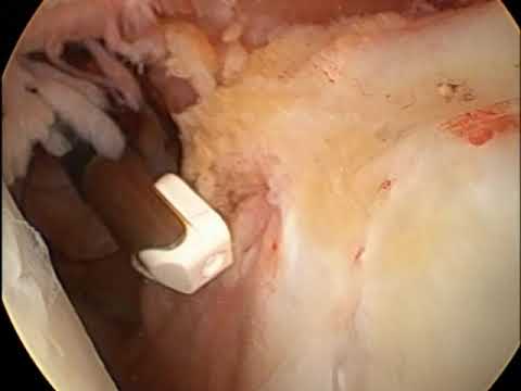 ROTATOR CUFF