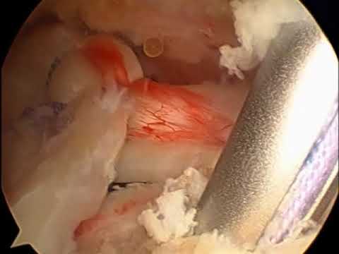 Ρήξη Rotator Cuff