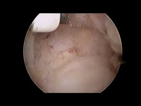 Αφαίρεση Τριγώνου Οσταρίου / Os trigonum removal Posterior ankle Arthroscopy