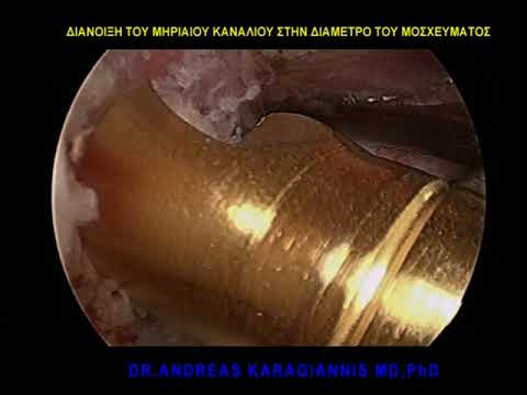 Ρήξη Προσθίου Χιαστού Συνδέσμου