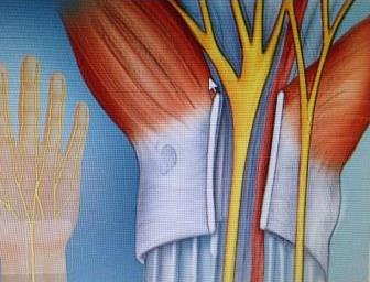 Σύνδρομο Καρπιαίου Σωλήνα(CARPAL TUNNEL SYNDROME)