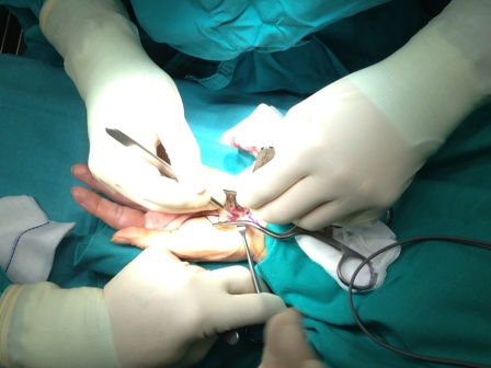 Σύνδρομο Καρπιαίου Σωλήνα(CARPAL TUNNEL SYNDROME)
