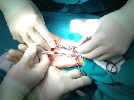 Σύνδρομο Καρπιαίου Σωλήνα(CARPAL TUNNEL SYNDROME)