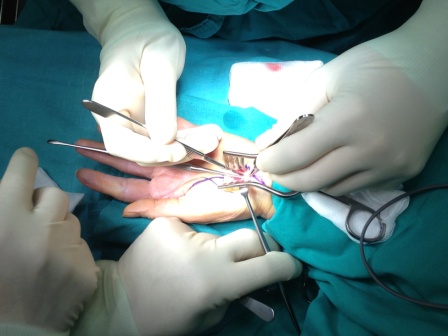 Σύνδρομο Καρπιαίου Σωλήνα(CARPAL TUNNEL SYNDROME)