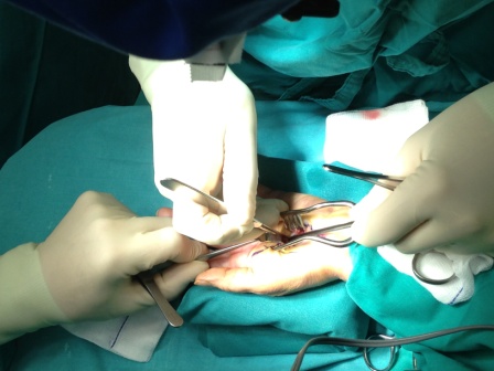 Σύνδρομο Καρπιαίου Σωλήνα(CARPAL TUNNEL SYNDROME)
