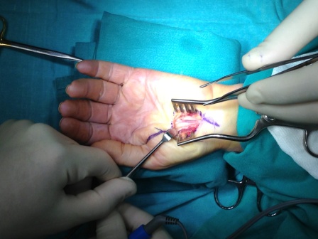 Σύνδρομο Καρπιαίου Σωλήνα(CARPAL TUNNEL SYNDROME)